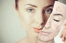 Substitución de Botox