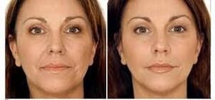 antes e despois