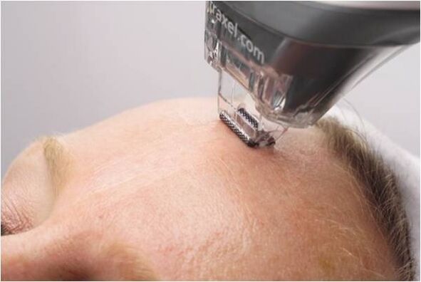 procedemento de peeling para o rexuvenecemento da pel facial